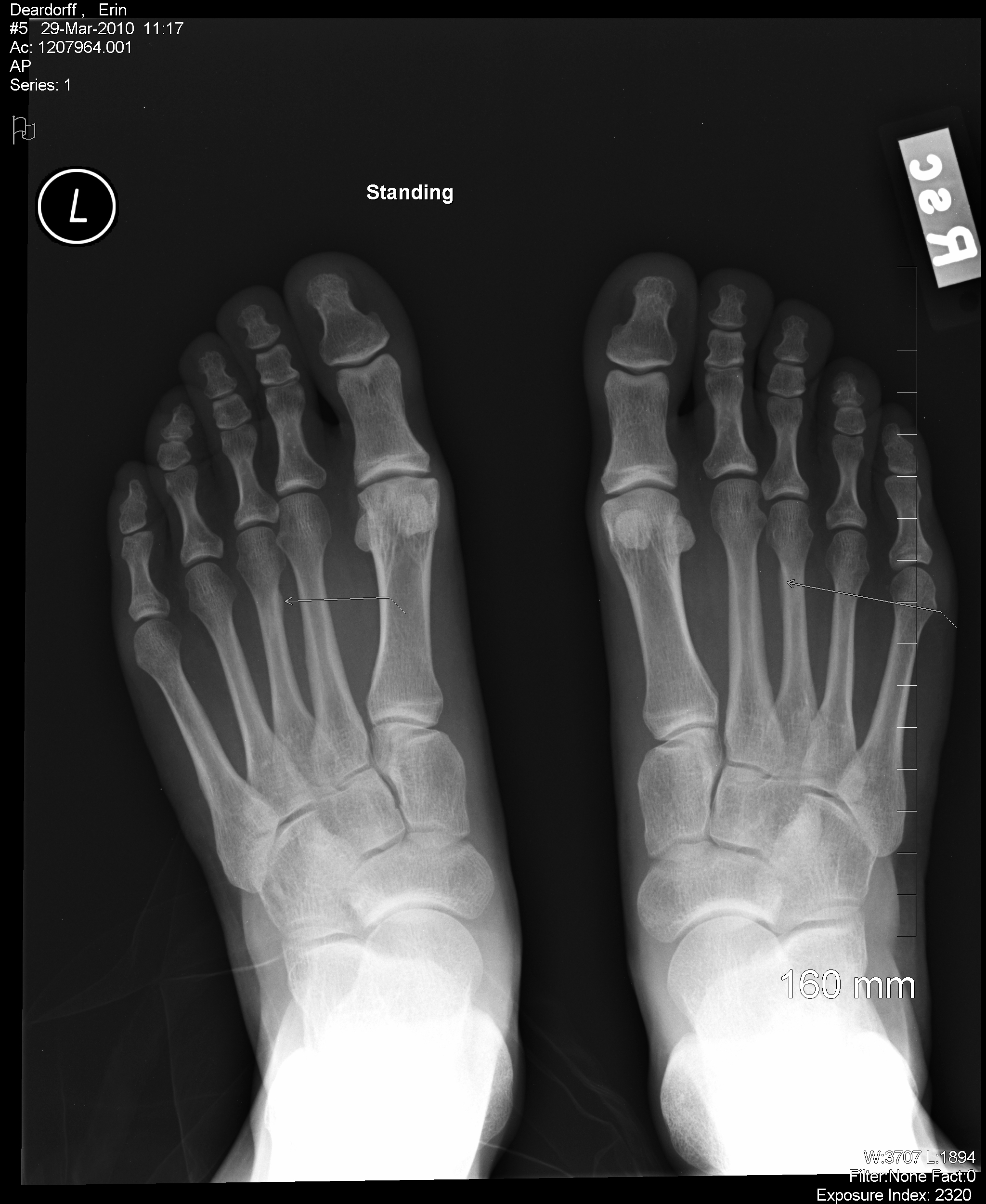 top of foot hairline fracture